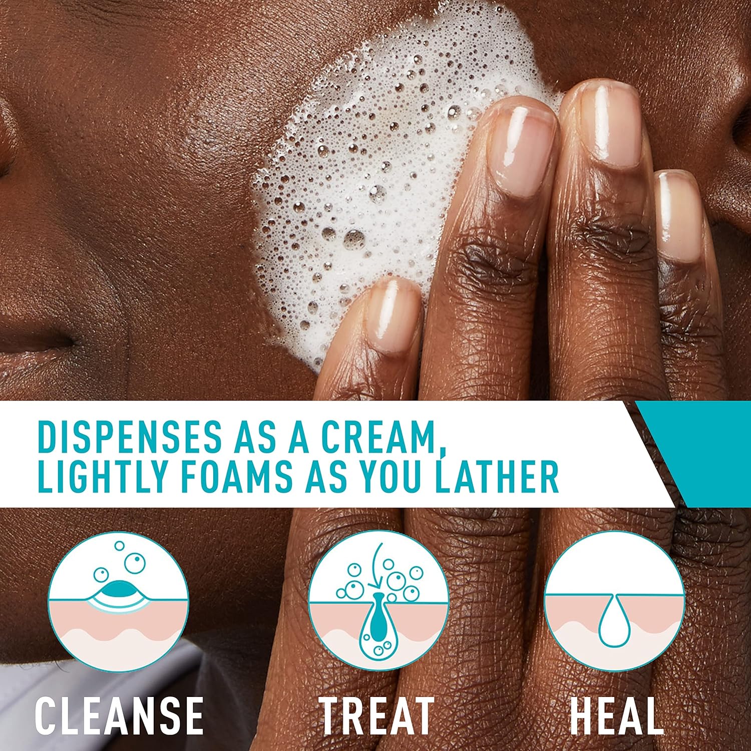 CeraVe Acne Foaming Cream Cleanser | Acne Treatment Face Wash with 4% Benzoyl Peroxide, Hyaluronic Acid, and Niacinamide | Cream to Foam Formula | Fragrance Free & Non Comedogenic | 5 Oz - 24hrsmart